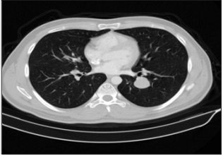 Rare Lung Tumors: Alveolar Adenoma-Four Case Reports