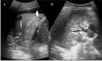 Diagnostic Value of Ultrasound in Detecting Causes of Pediatric Chest X-Ray Opacity